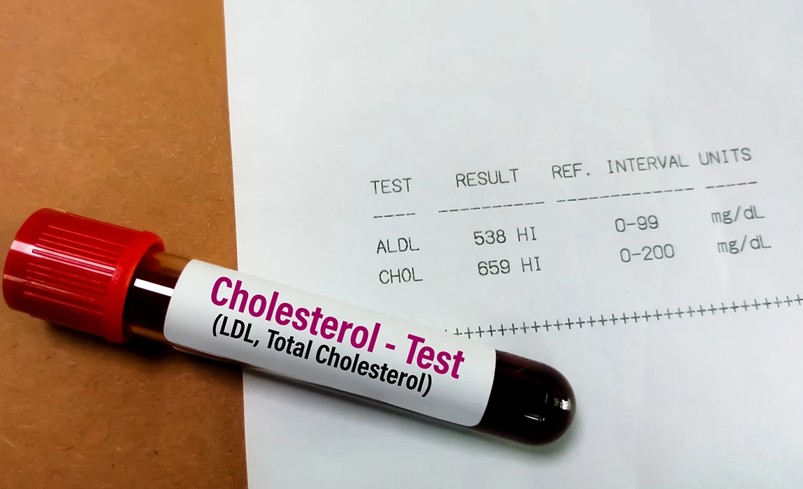Próbka krwi oznaczona jako „Test cholesterolu” znajduje się obok wyniku testu, który pokazuje wysoki poziom ALDL (538 mg/dl) i cholesterolu (659 mg/dl), oba powyżej przedziałów referencyjnych.