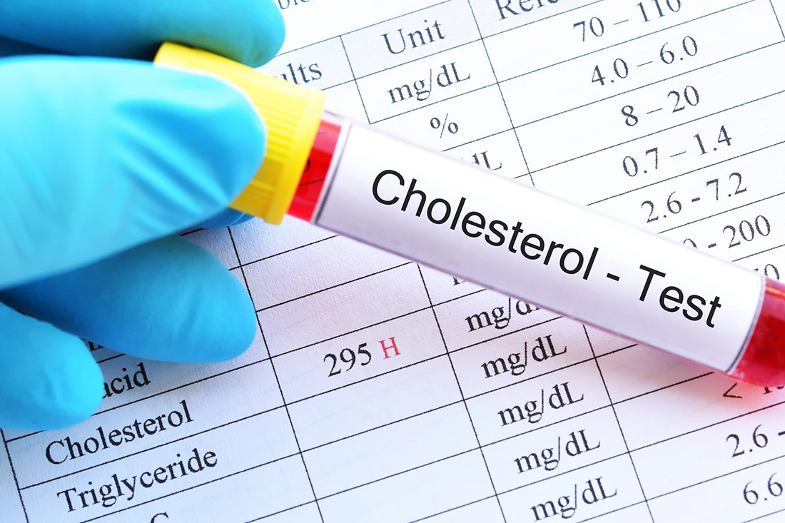 Dłoń w rękawiczce trzyma próbkę krwi z etykietą „Cholesterol - Badanie” nad arkuszem wyników badania cholesterolu, w którym widnieją różne wartości krwi.