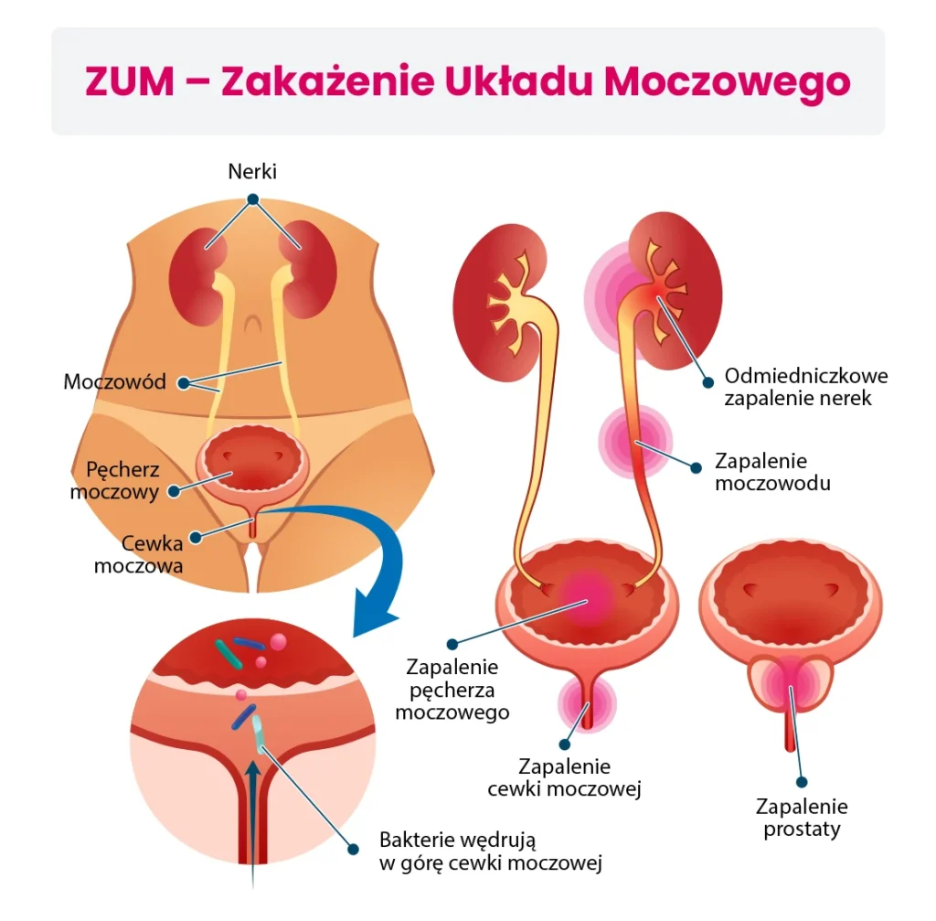 Schemat w języku polskim przedstawiający zakażenie układu moczowego, oznaczający nerki, pęcherz moczowy, cewkę moczową, prostatę oraz podkreślający miejsca zakażenia i przemieszczanie się bakterii w górę układu moczowego.