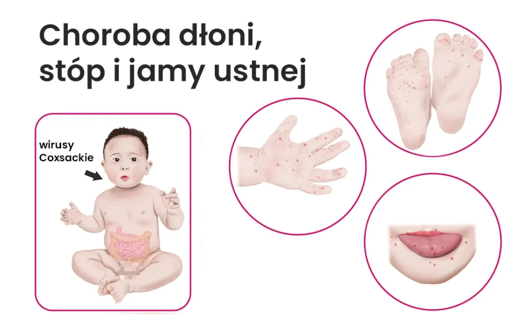 Schemat przedstawiający dziecko z czerwonymi plamami na dłoniach, stopach i ustach, oznaczone jako Choroba dłoni, stóp i jamy ustnej (Hand, foot, and mouth disease) ze strzałką wskazującą na wirusy Coxsackie.