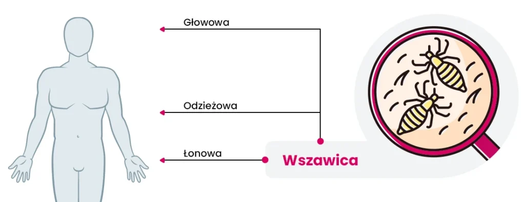Schemat przedstawiający postać ludzką ze strzałkami wskazującymi głowę, ciało i okolice łonowe, oznaczone w języku polskim, obok powiększonego obrazu wszy pod lupą.