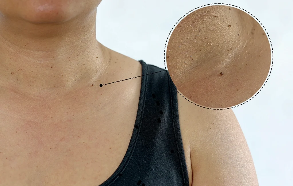 Zbliżenie górnej części klatki piersiowej osoby z powiększonym widokiem podkreślającym mały pieprzyk na skórze.