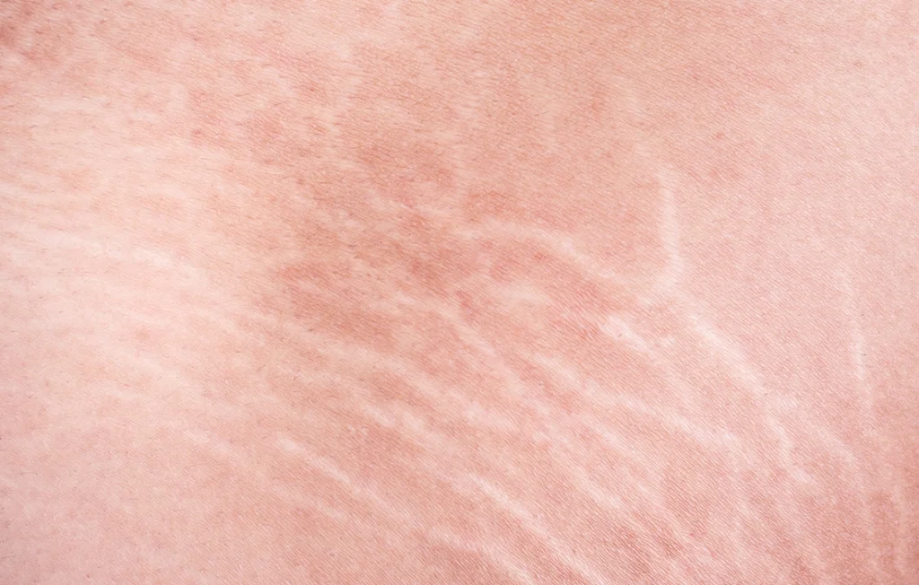 Zbliżenie jasnej skóry z widocznymi rozstępami w białych i różowawych odcieniach, ukazujące naturalną teksturę i wzory skóry.