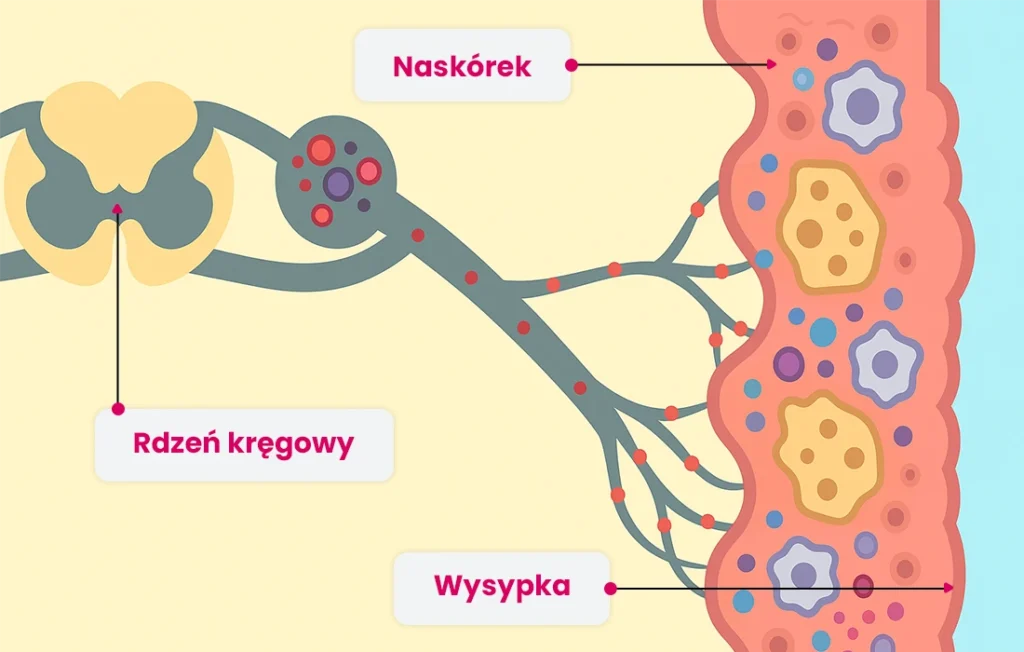 Schemat przedstawiający nerwy od rdzenia kręgowego do skóry (naskórek), z zaznaczoną wysypką na powierzchni skóry i oznaczonymi częściami w języku polskim.